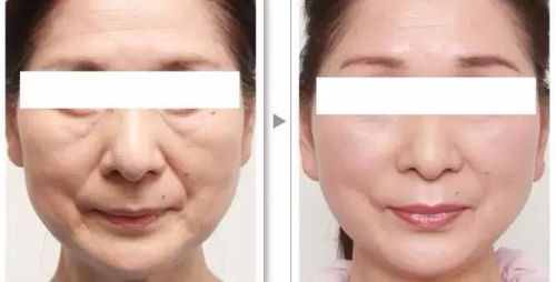 医院医生正在为患者去除面部痣