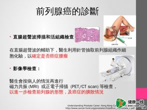 医生正在讲解前列腺癌治疗方案