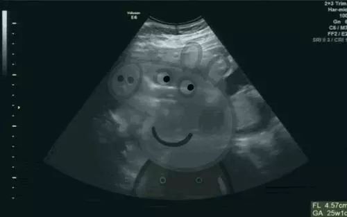 猪妈妈手持粉色B超照片亮相节目