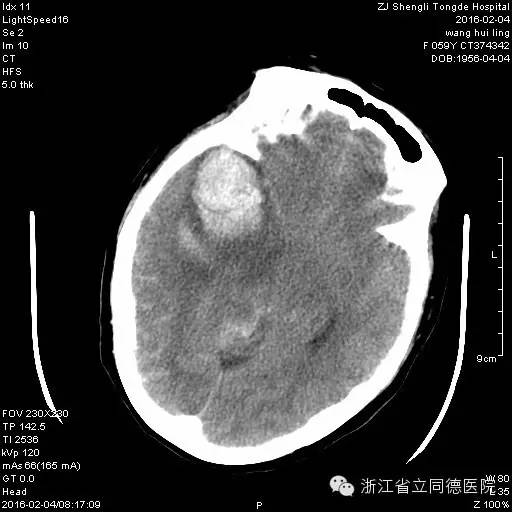 颅内动脉瘤结构示意图展示血管异常扩张部位
