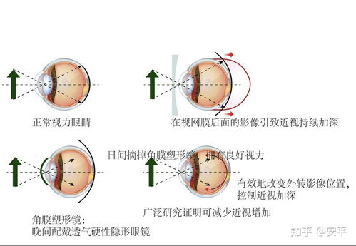 一副整齐摆放的儿童角膜塑形镜