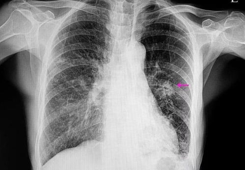 肺结节不是小事！女子查出没在意，一年后竟成肺癌晚期