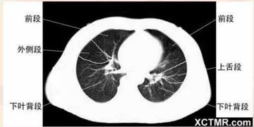 27岁福建女子忽视肺结节，一年后确诊肺癌转移的警示故事