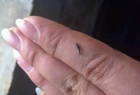 被隐翅虫毒液腐蚀后的皮肤红肿水泡