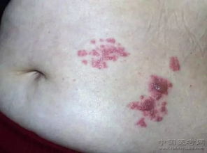 带状疱疹科普宣传资料