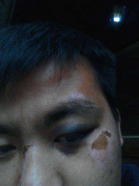 66岁大爷挖鼻孔致满脸肿胀变形，网友直呼：太吓人了！