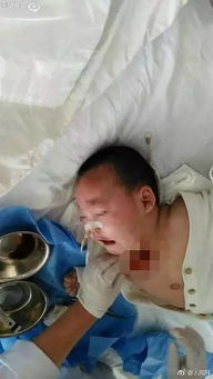 13岁女孩心脏扎进细针 紧急转院：生死一线的惊心动魄时刻