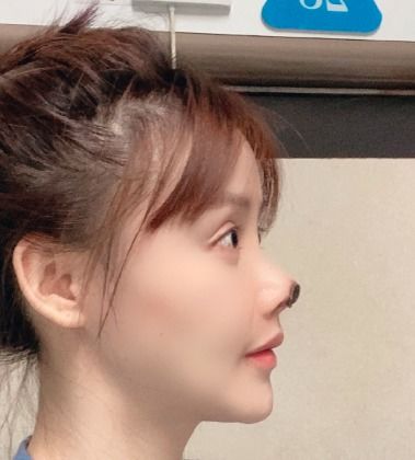 女演员高溜整容失败后的真实面貌