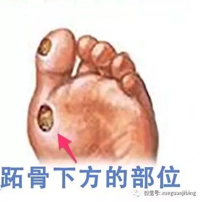 糖尿病患者日常脚部护理步骤图示