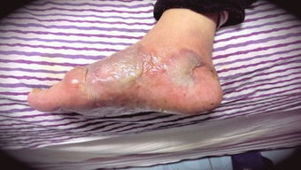 糖尿病患者脚部轻微烫伤