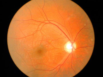 视神经萎缩患者眼中模糊的世界