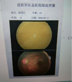 女孩双眼青紫肿胀如核桃状