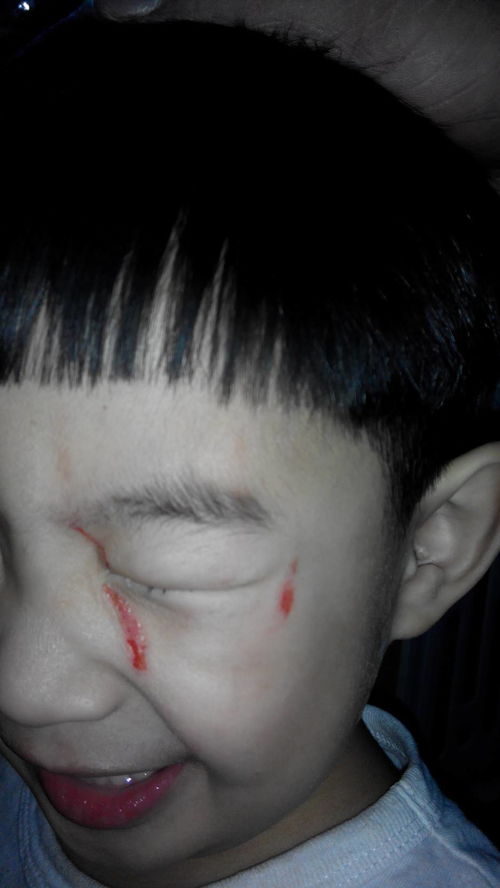 孩子脸上有伤痕