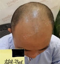 植发前后对比图示例