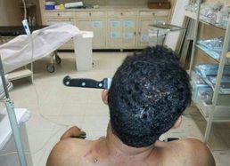 烧烤签穿颈惊魂！男子命悬一线，急救人员紧急救援全过程曝光