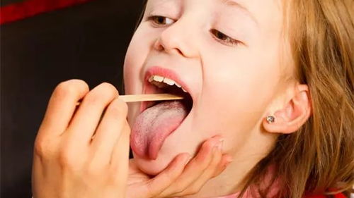 医生讲解鱼刺卡喉的危害示意图