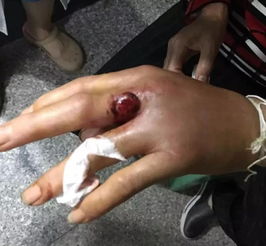 女子被毒蛇咬伤送医身亡，医院回应引争议！这些急救知识你必须知道