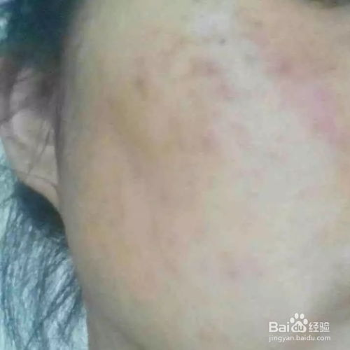 脸部红斑过敏照片示例