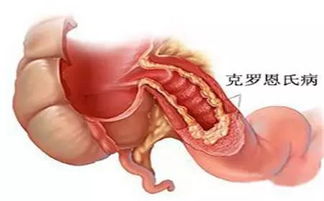 克罗恩病女孩微笑面对镜头