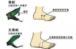 急救人员正在处理被蛇咬伤患者