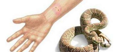 三亚女子被蛇咬伤致死，伤口曝光引发全民关注！