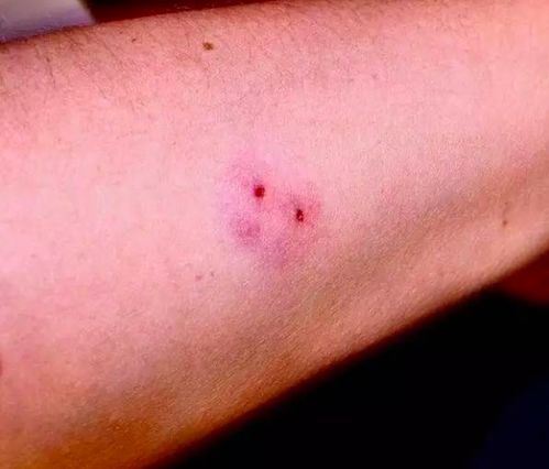 三亚毒蛇咬伤致死事件背后：伤口画面曝光，急救黄金两小时为何错失？