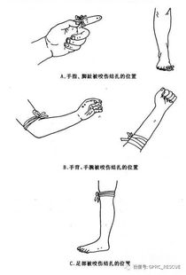 毒蛇咬伤急救示意图