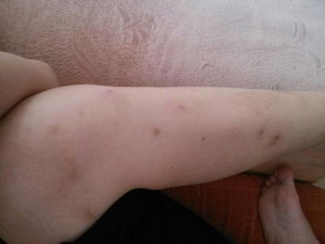 蚊子叮咬后留下的黑色痕迹图片