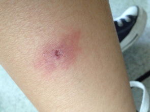 蚊子叮咬后皮肤起红肿包的图片