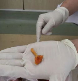 湖南一家六口误食毒蘑菇，5岁男童肝坏死！姑姑含泪愿捐肝救侄子