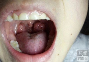 口腔感染导致颈部肿胀示意图