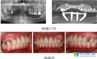 种植牙前后对比图