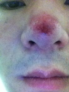 鼻子红肿化脓的医疗图片