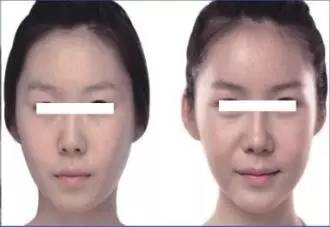 瘦了20斤的面部变化：从自我怀疑到自信绽放的真实蜕变