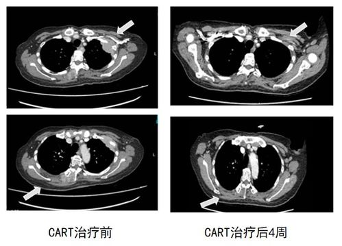 钇-90治疗前后CT对比图
