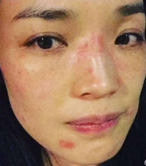 女子脸部红肿过敏特写