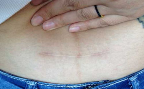 王灿展示剖腹产疤痕