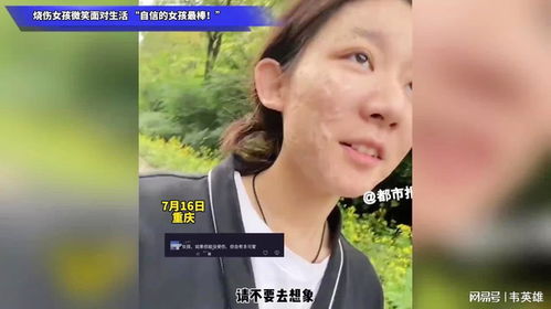 烧伤85%女孩与同年同月同日生未婚夫订婚：爱，从不问伤痕