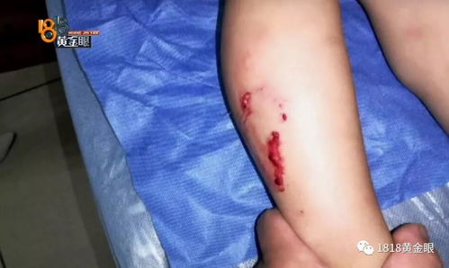 被狗咬未就医3个月后发病去世，狂犬病真的能拖吗？