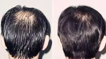 卫健委辟谣频繁洗头导致脱发，真相竟然是这样？