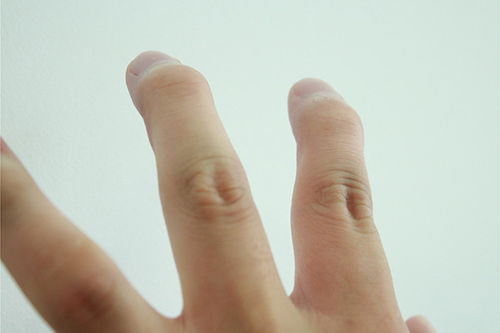 老中医把脉指甲太长留下印痕 男子索赔2000元引发热议