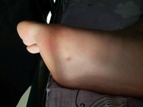 网友住酒店光脚洗澡竟感染HPV，这些细节要注意！