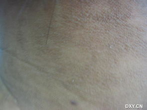 黑棘皮病皮肤表现示意图