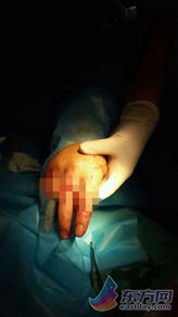 受虐者受伤的手指