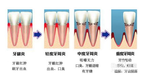 牙周炎可能导致牙齿松动脱落