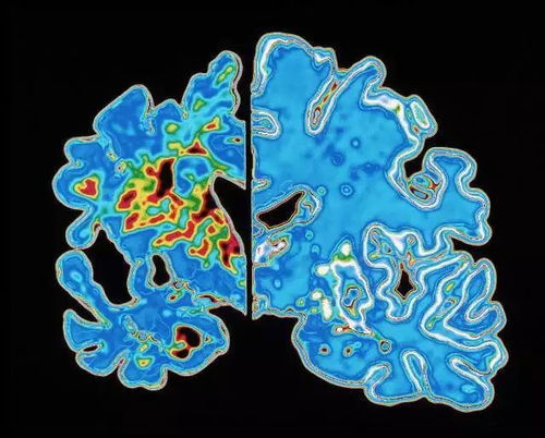 阿尔茨海默病手术被叫停背后的真相