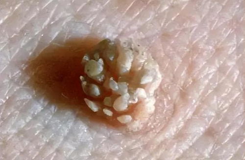 皮肤上出现的小肉球