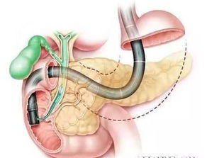 郑钦文做手术的示意图