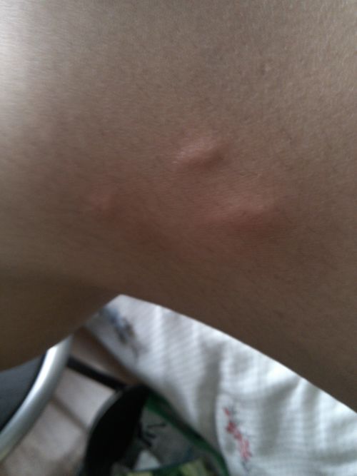 被蚊子叮咬后红肿的皮肤