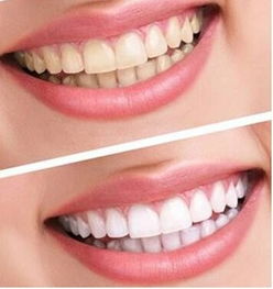 超赞！美团买单带你体验洗牙之旅